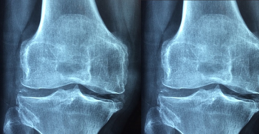 Knee Replacement Surgery : Types & Causes