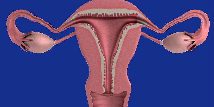 Top Five Herbal Remedies for an Ovarian Cyst