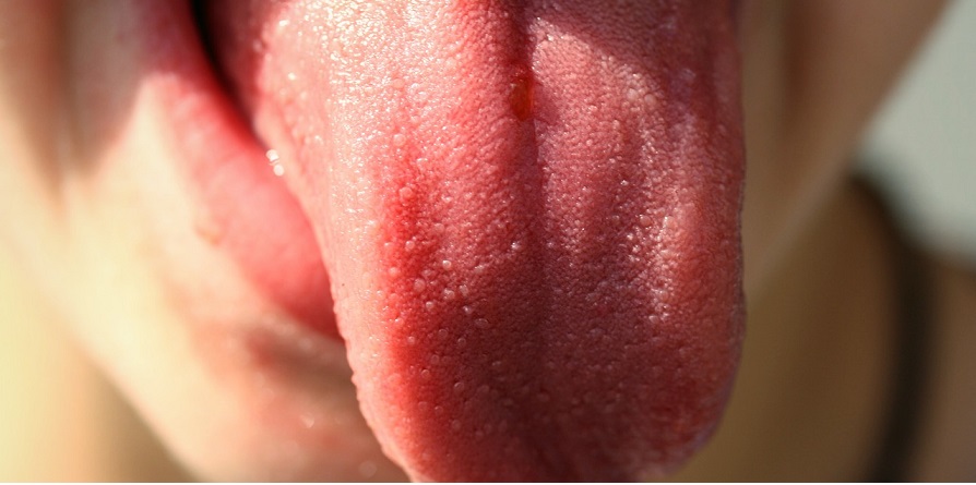 Tongue Ulcer : Causes & Symptoms